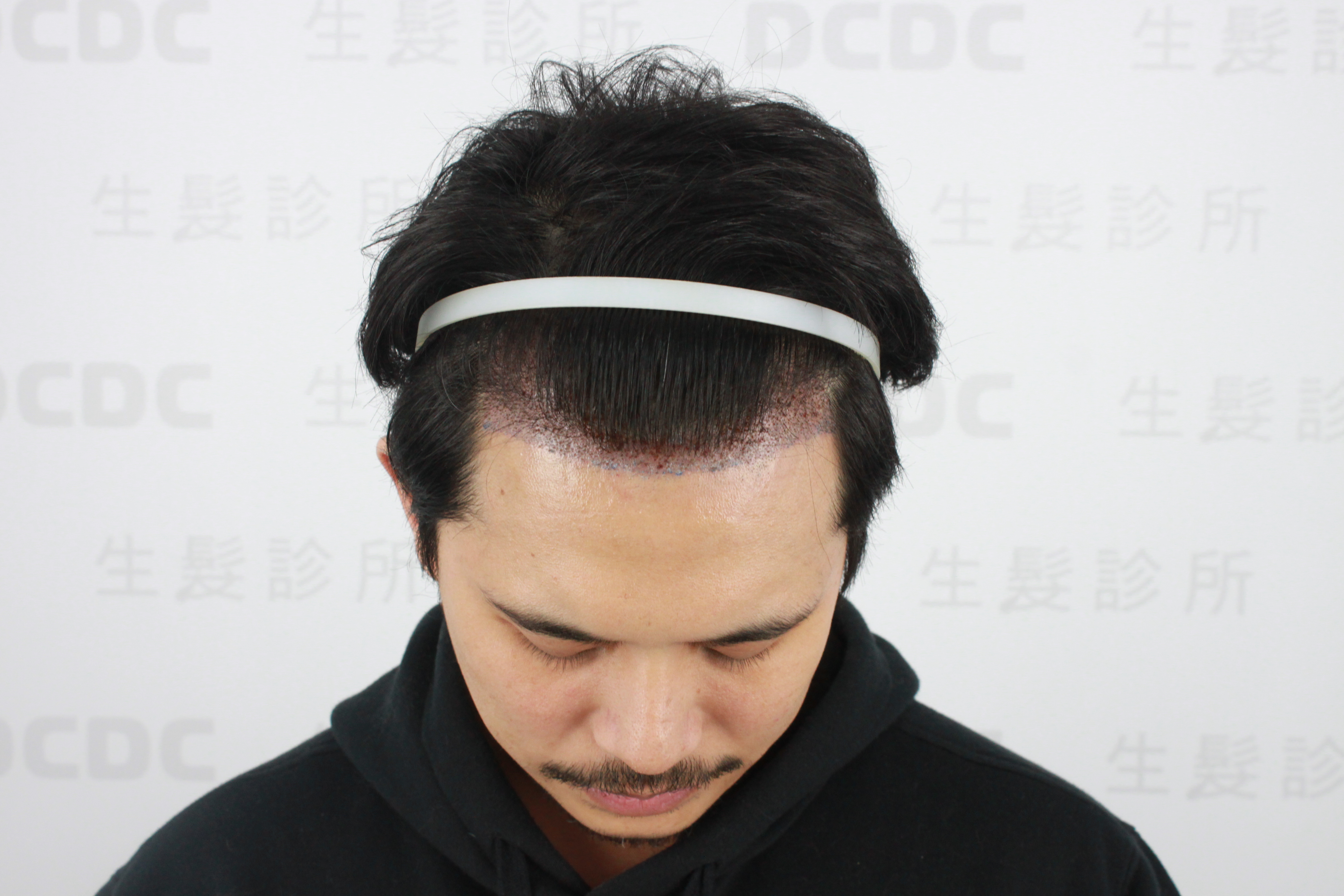 DCDC生髮診所-FUE分層剃髮植髮術後隔天後枕部取髮區隱形無痕